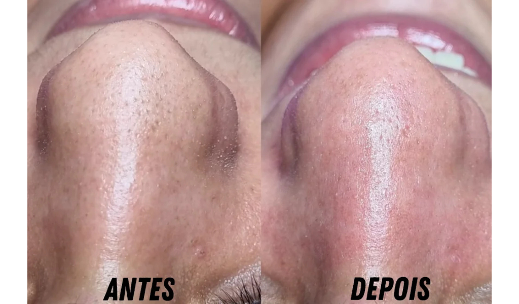 Antes e Depois Limpeza de Pele